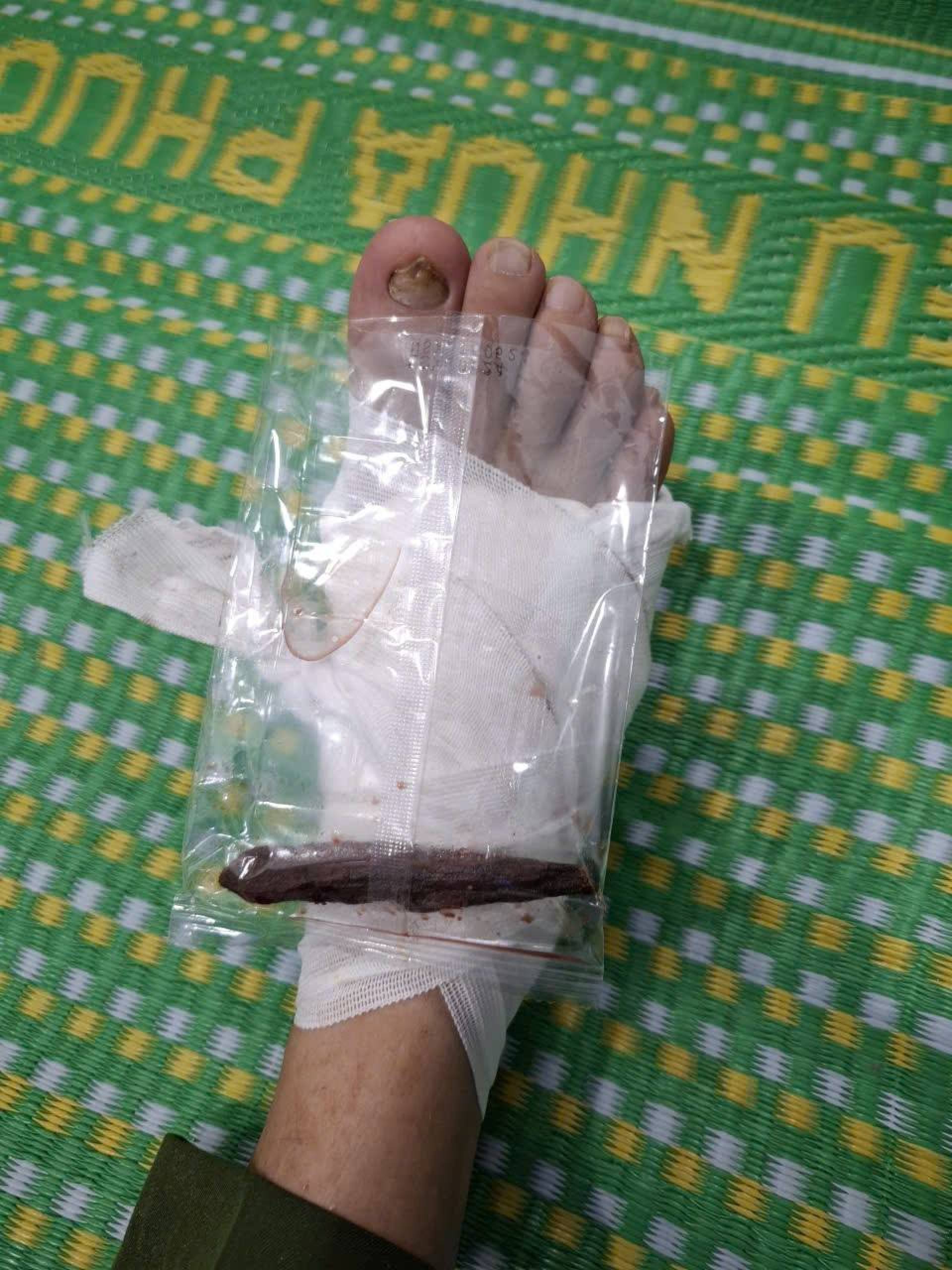 广南省一乡公安局长在帮助民众抗洪时被木棍刺穿脚掌